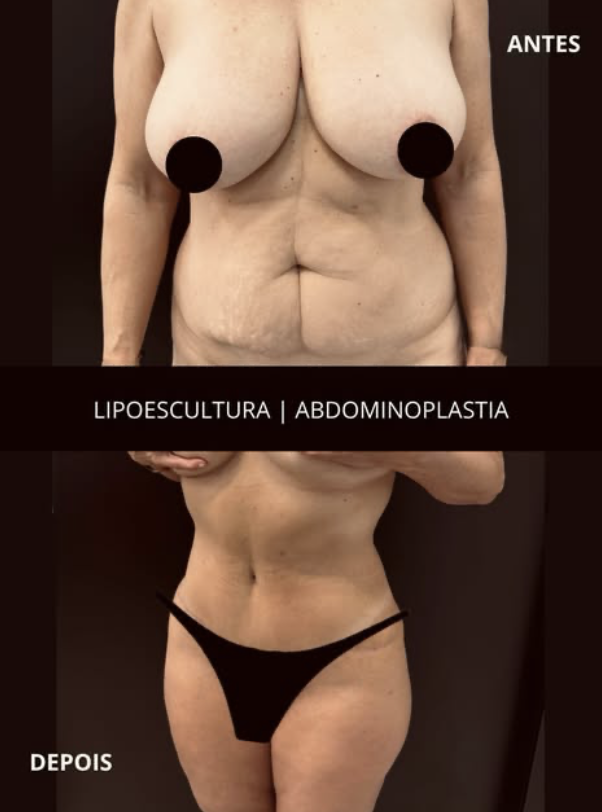 Registro comparativo de antes e depois de lipoabdominoplastia